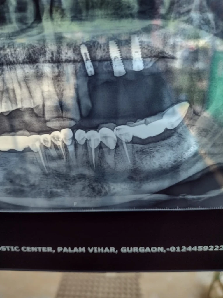 Panoramic X-ray showing placed implants